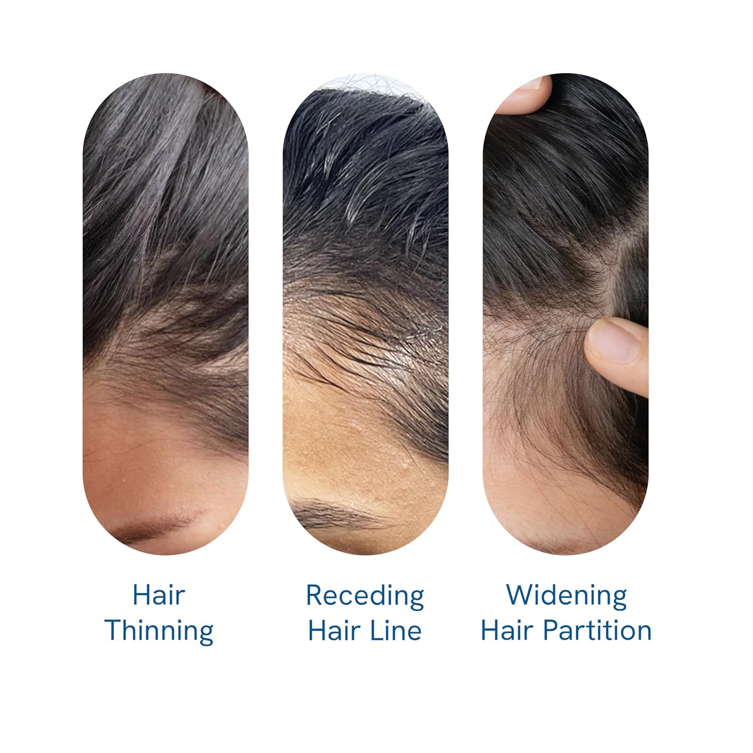Advanced Hair Growth Serum Roll-On with Rosemary Oil, Redenex & Anaflex - 25ml