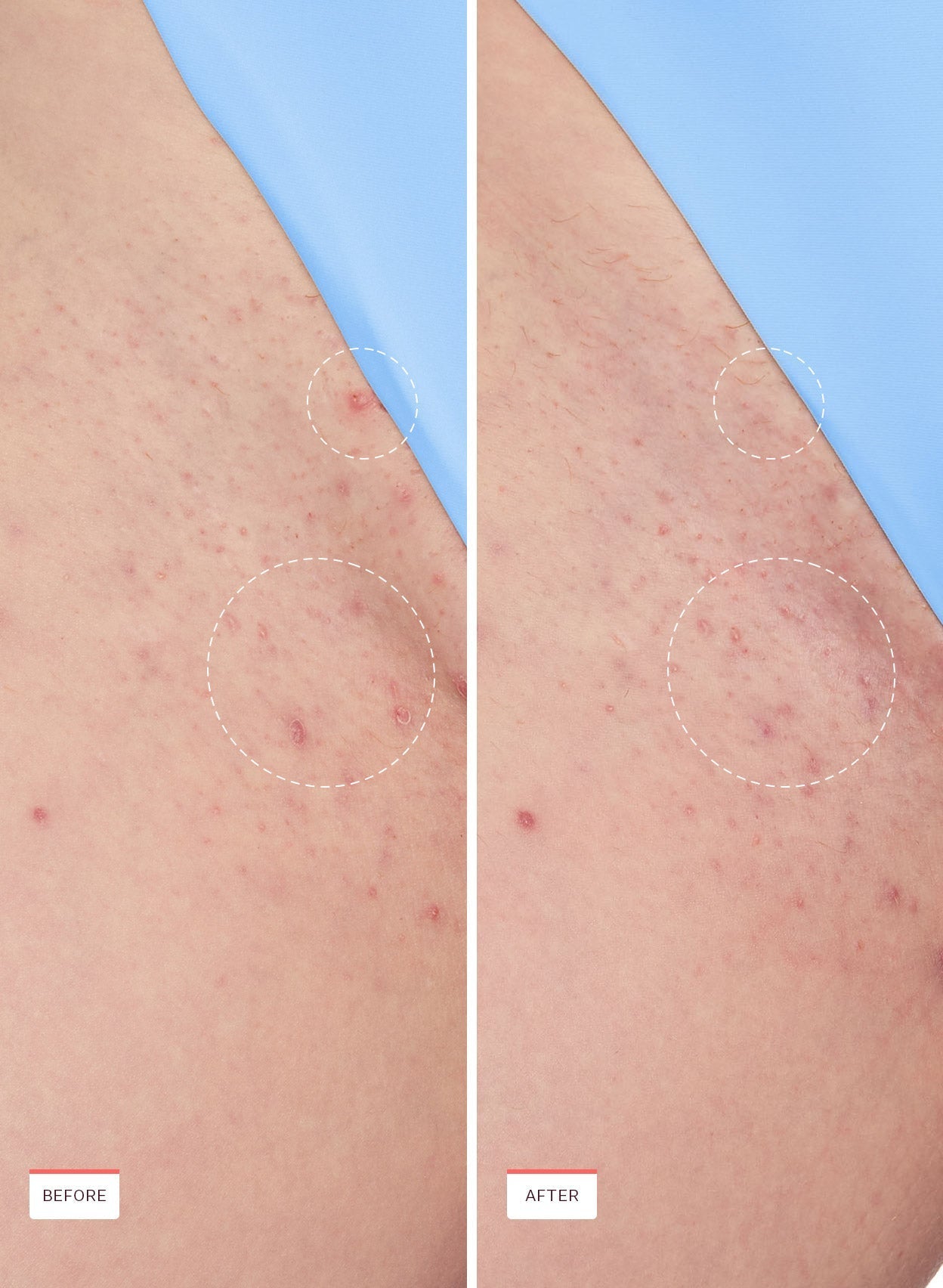 Smoothing Solution Ingrown Hair Serum for Razor Bumps & Smooth Skin